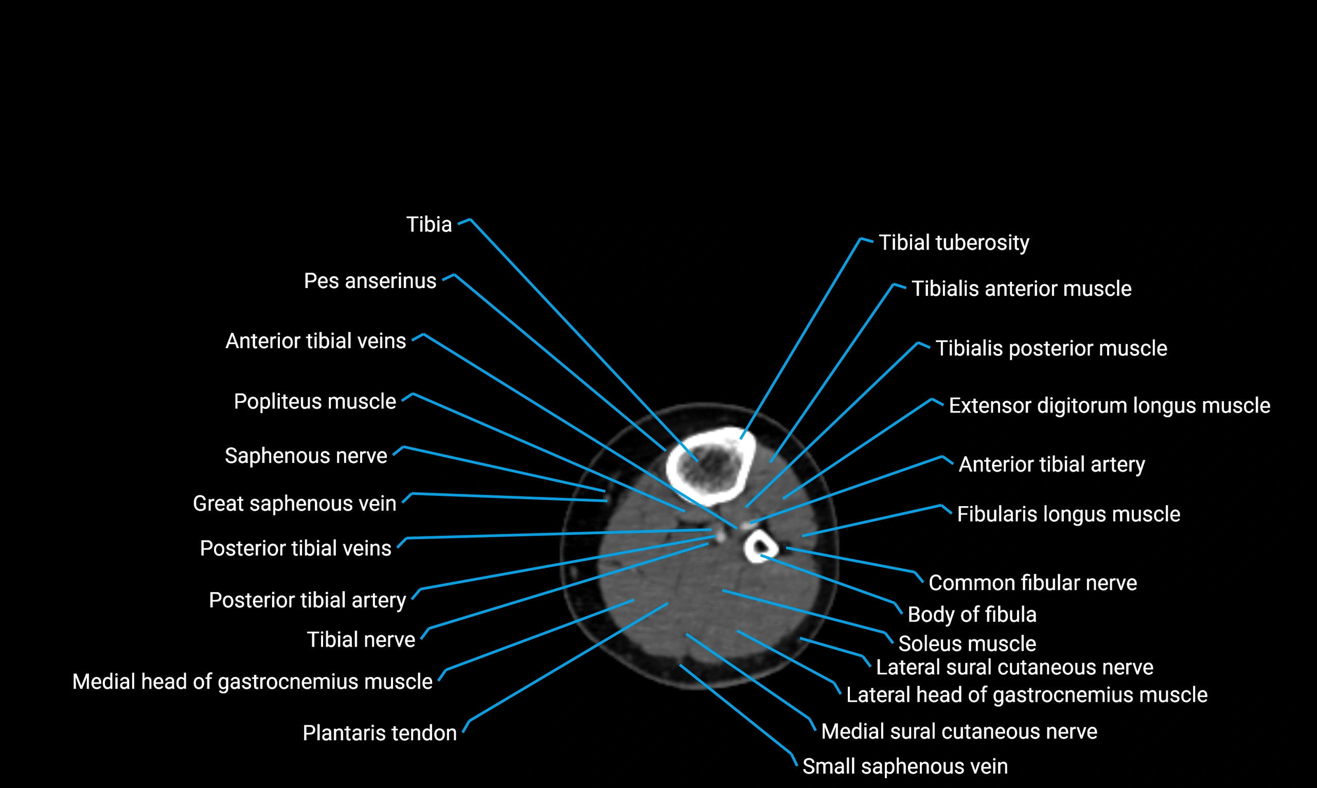 CT lower limb axial cross sectional anatomy labelled image 102 (2).webp